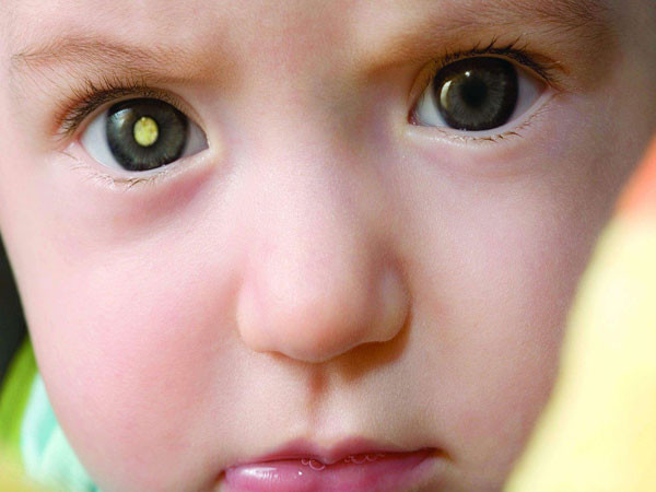 أعراض أمراض شبكية العين عند الأطفال وأنواعها | أهل مصر