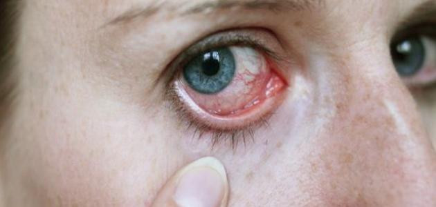 أمراض شبكية العين