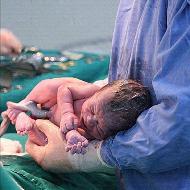 الولادة القيصرية