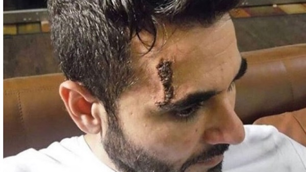 إصابة أحمد عز