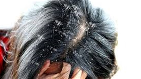 وصفات منزلية للتخلص من قشرة الشعر