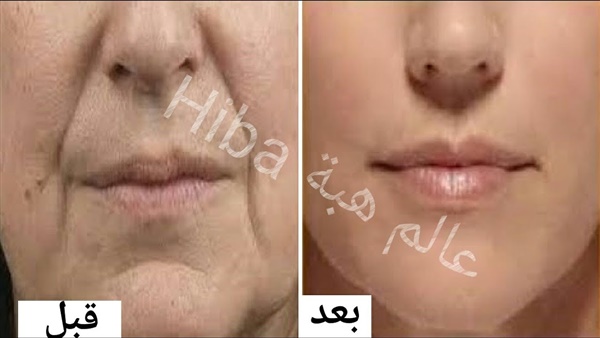 علاج تجاعيد الفم
