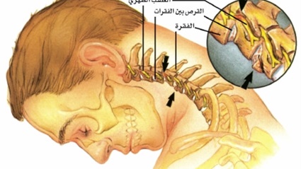 أسباب آلام الرقبة