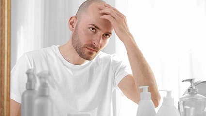 علاج صلع الرجال بالطب