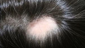 5 وصفات طبيعية لعلاج
