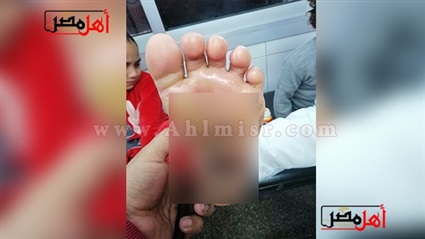 جمراء على الفخذين
